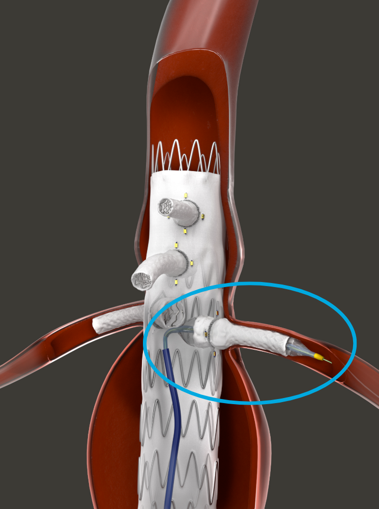 The Bentley BeFlared: the first dedicated bridging stent for complex FEVAR interventions, allowing precise deployment in one step.