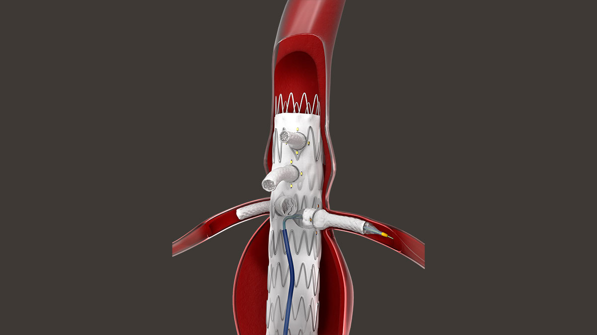 The Bentley BeFlared: the first dedicated bridging stent for complex FEVAR interventions, allowing precise deployment in one step.